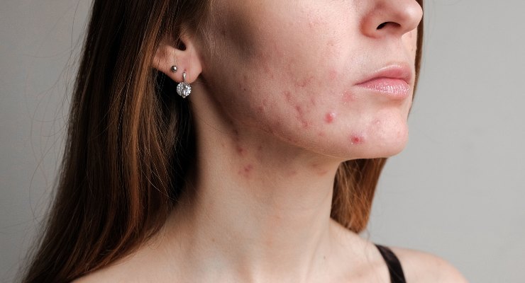 mujer con acne síntoma de desequilibrio hormonal