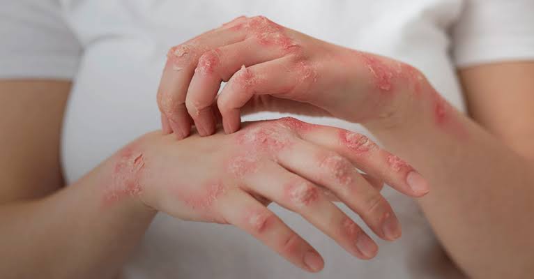 manos con lesiones por lupus